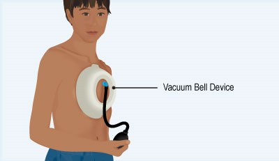 Vacuum Bell device on chest